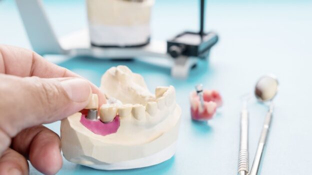 implant dentar bucuresti pentru oricine