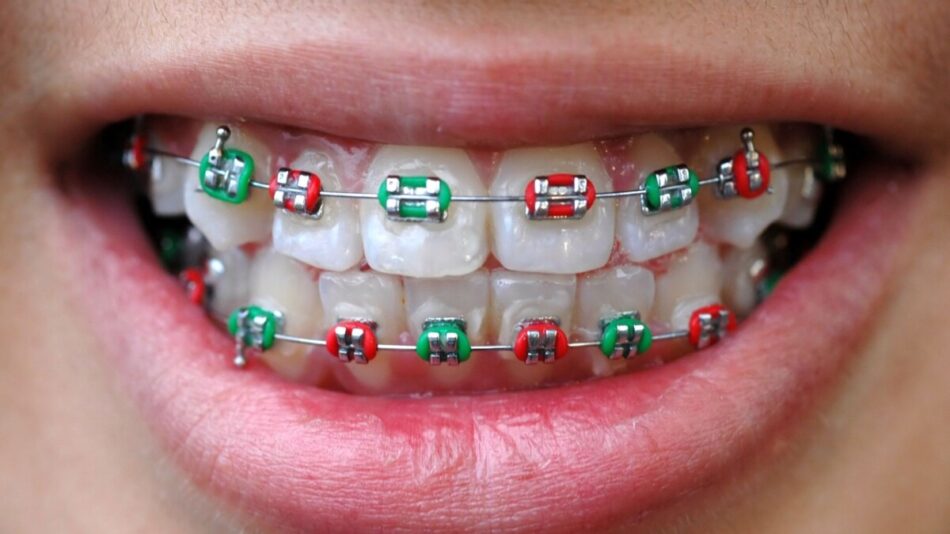 Aparate dentare cu elastice colorate